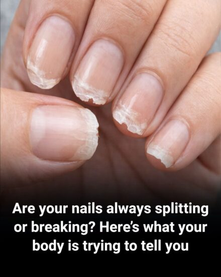 Weak or Brittle Nails: What Your Body Is Trying to Tell You