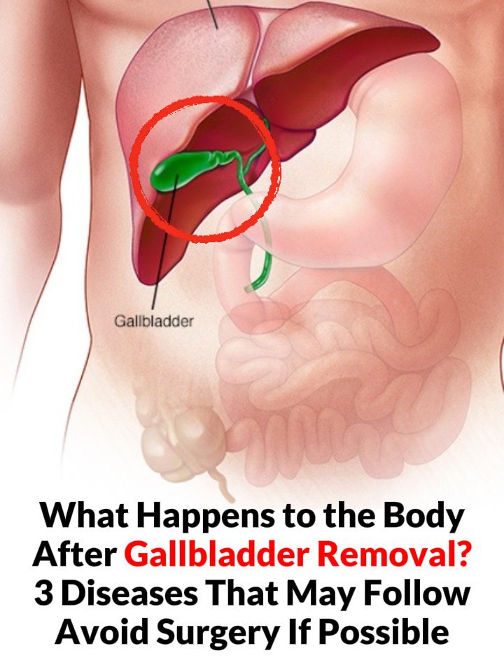 Life After Gallbladder Removal: Honoring Your Body’s Quiet Wisdom